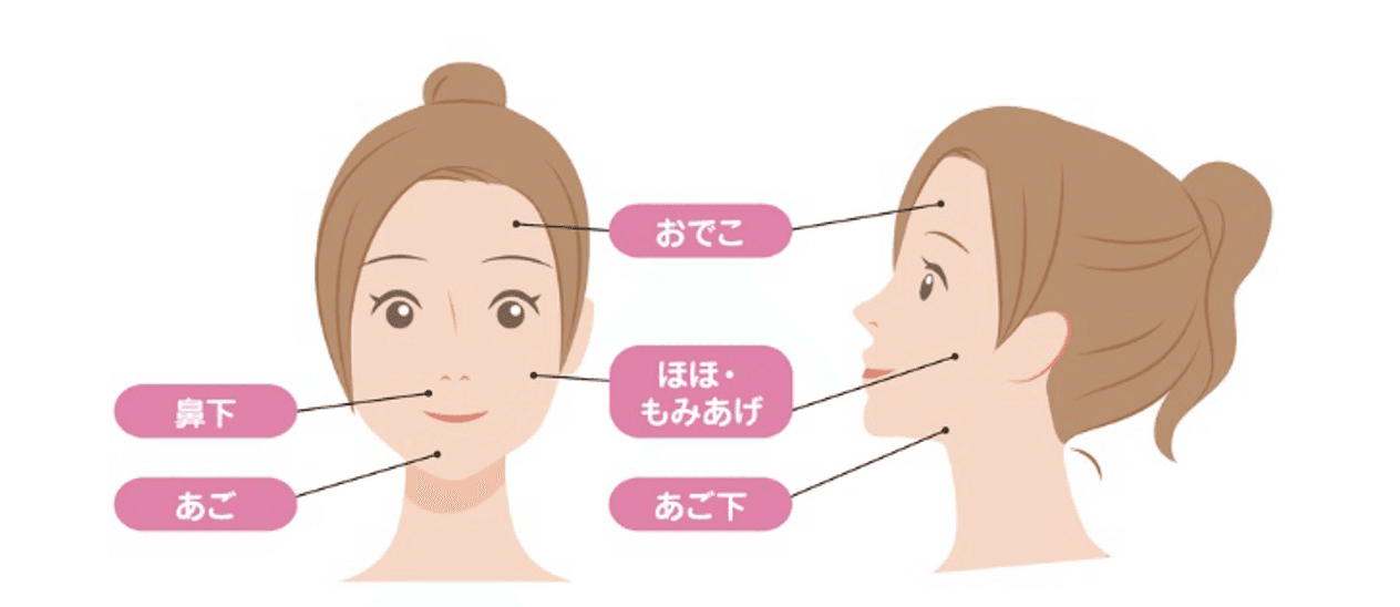 さいたま市大宮で医療脱毛を行っている松沢医院の女性医療脱毛（顔）部位のイメージ